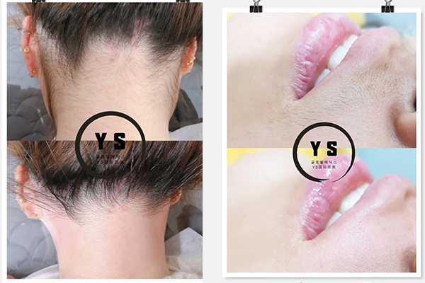  嘿嘿视频在线观看YS水晶脱毛与传统蜜蜡脱毛的区别